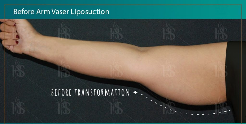 Arm-Vaser-Liposuction-1-min-1024x1024-1 1