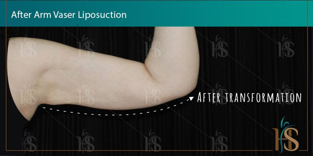Arm-Vaser-Liposuction-2-min-1024x1024-1 2
