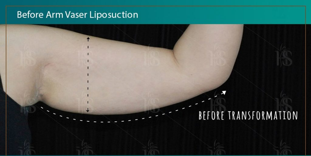 Arm-Vaser-Liposuction-3-min-1024x1024-1 1