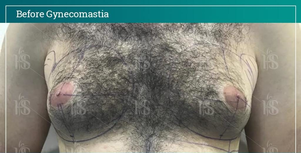 Gynecomastia-1-1024x1024-1 1