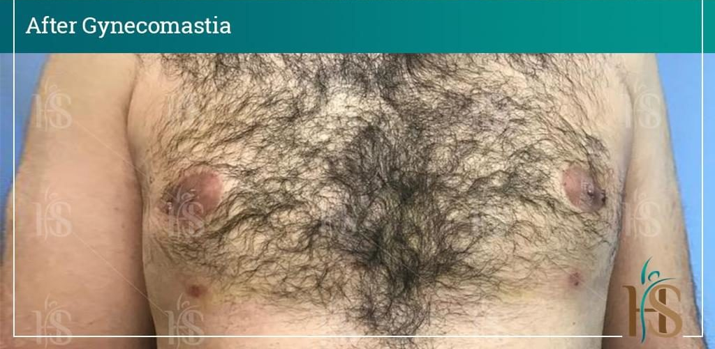 Gynecomastia-1-1024x1024-1 2