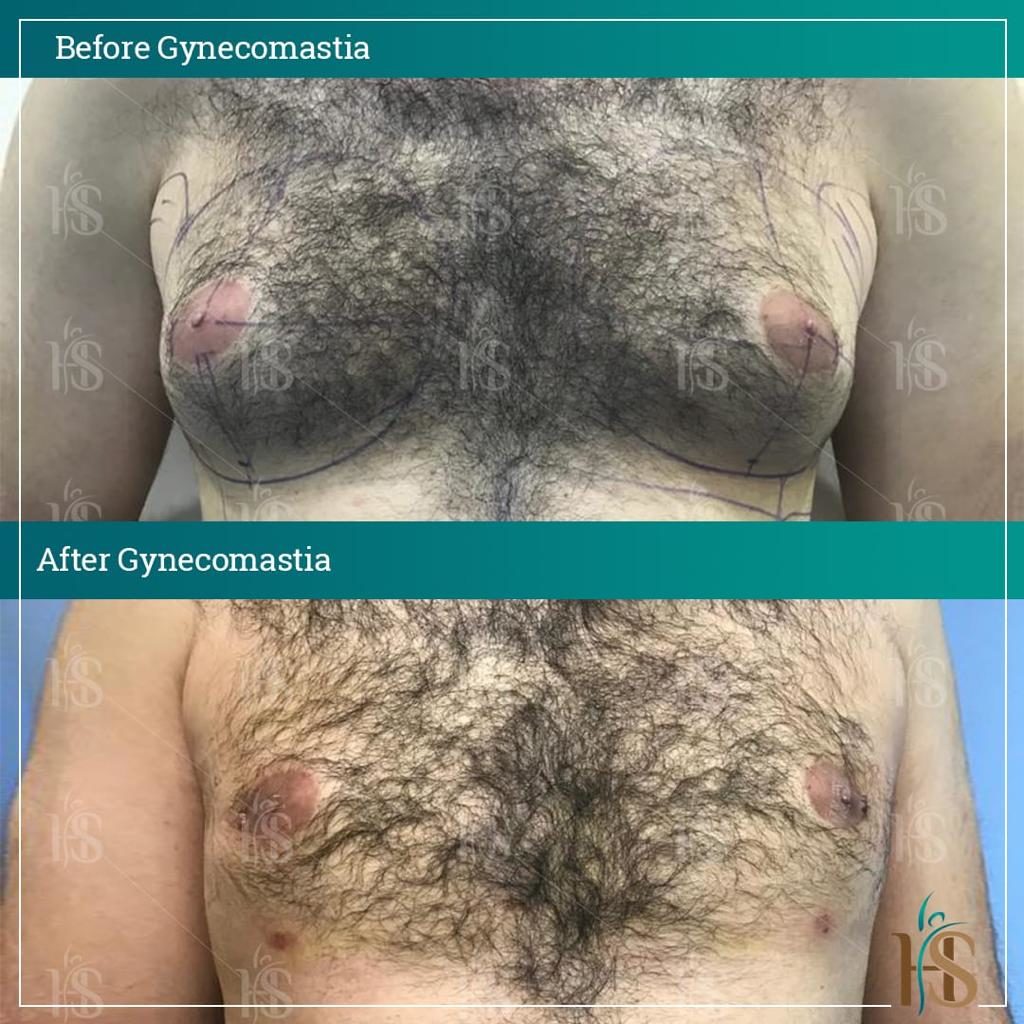 Gynecomastia-1-1024x1024