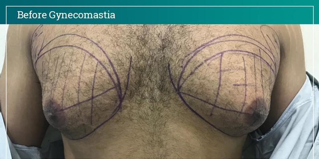 Gynecomastia-2-1024x1024-1 1