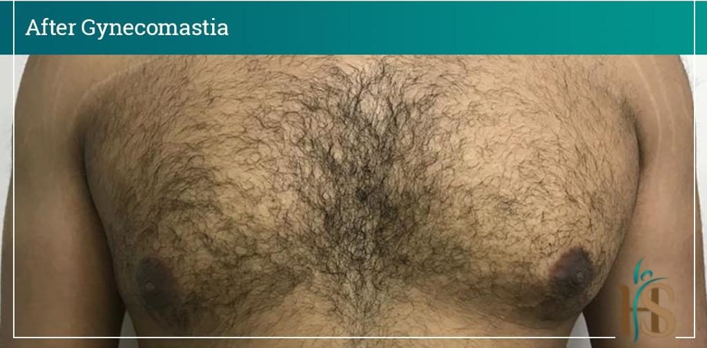 Gynecomastia-2-1024x1024-1 2