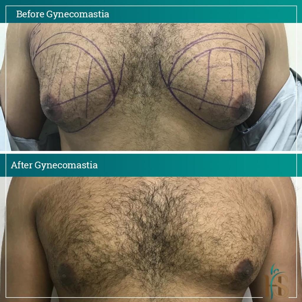 Gynecomastia-2-1024x1024