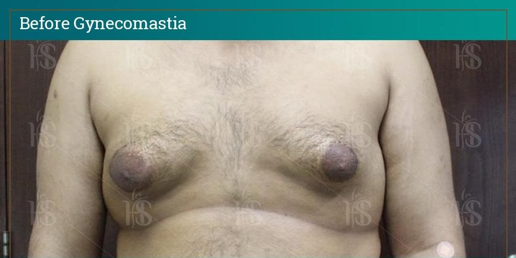 Gynecomastia-3-min-1024x1024-1 1