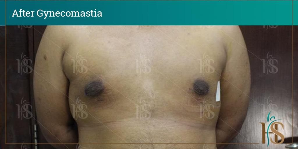 Gynecomastia-3-min-1024x1024-1 2