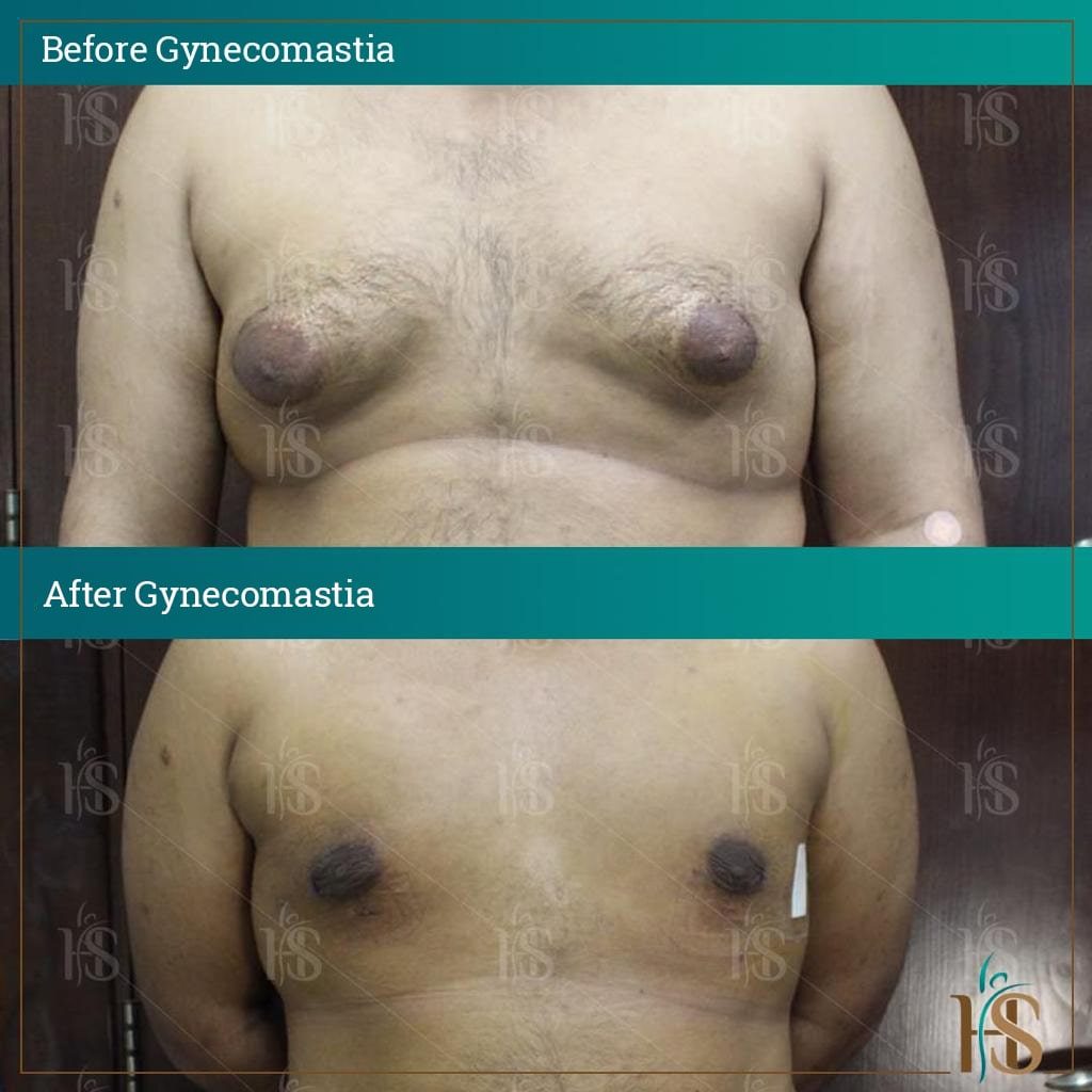 Gynecomastia-3-min-1024x1024