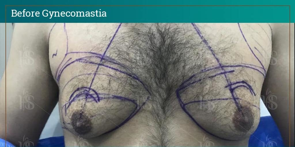 Gynecomastia-5-min-1024x1024-1 1