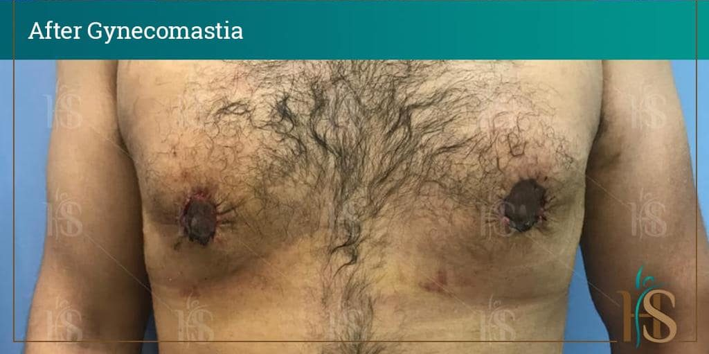 Gynecomastia-5-min-1024x1024-1 2