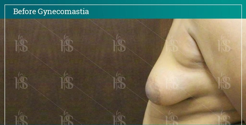 Gynecomastia-7-1024x1024-1 1