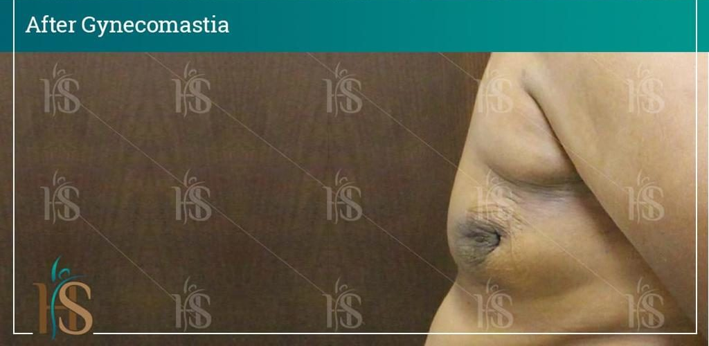 Gynecomastia-7-1024x1024-1 2