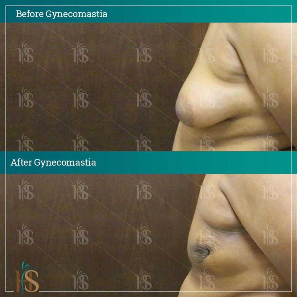 Gynecomastia-7-1024x1024