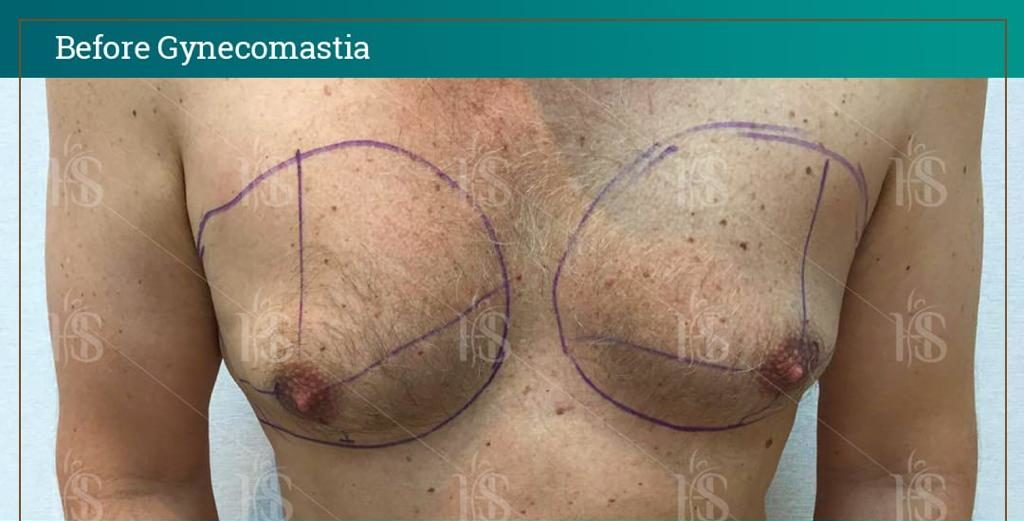 Gynecomastia-9-1024x1024-1 1