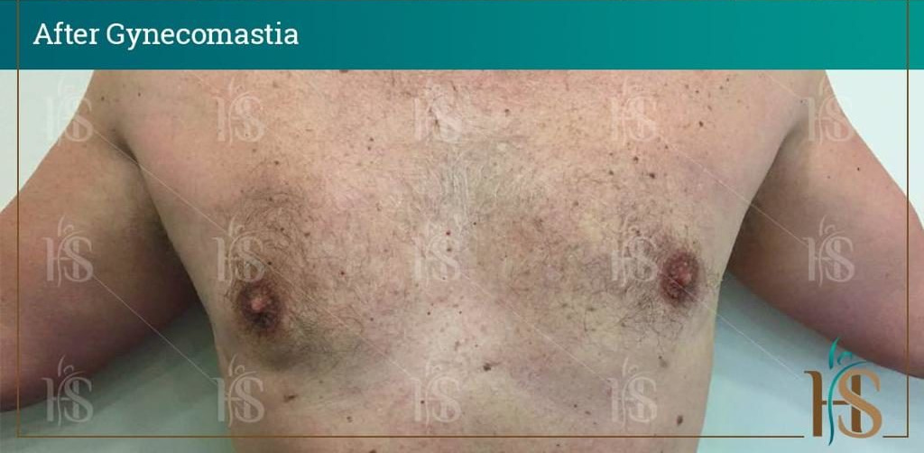 Gynecomastia-9-1024x1024-1 2