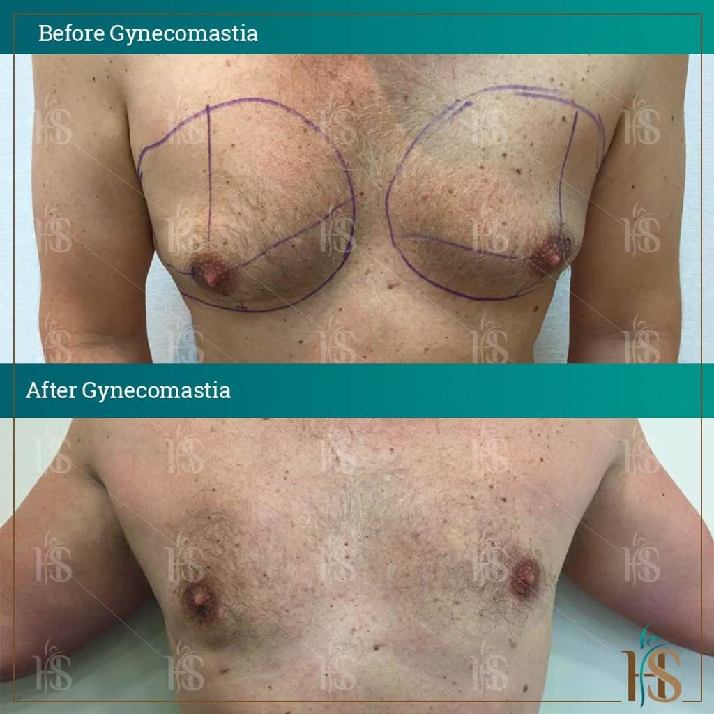 Gynecomastia-9-1024x1024