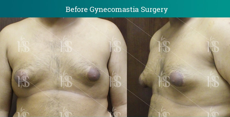 Gynecomastia-Surgery_10535-min 1