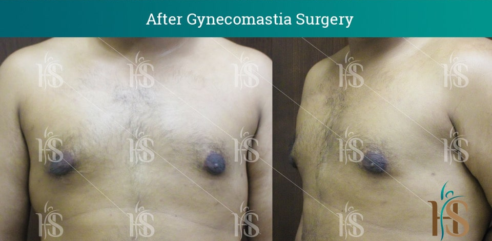 Gynecomastia-Surgery_10535-min 2