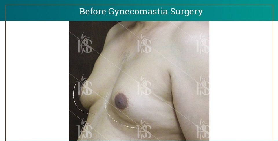 Gynecomastia-Surgery_10616-min 1