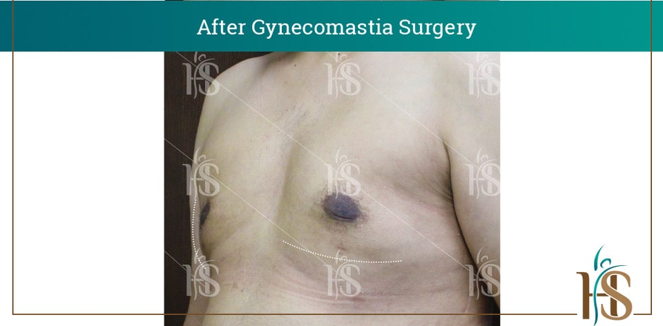 Gynecomastia-Surgery_10616-min 2