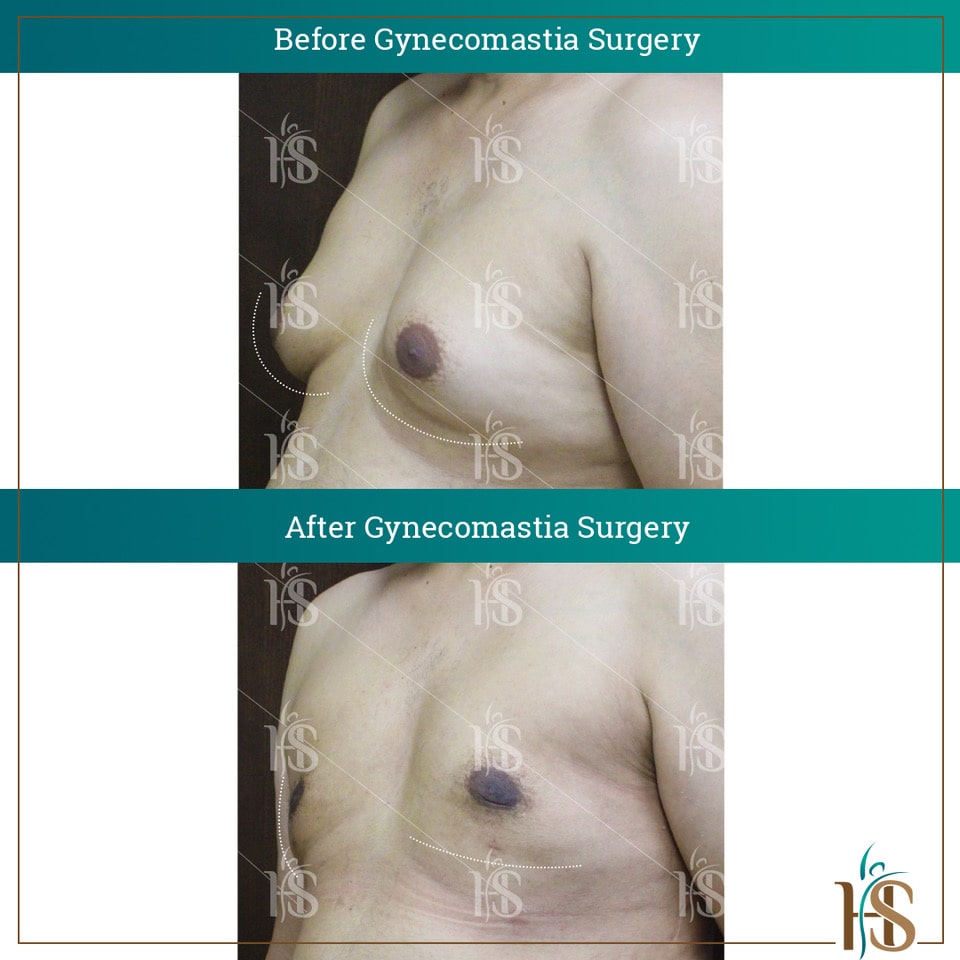 Gynecomastia-Surgery_10616-min