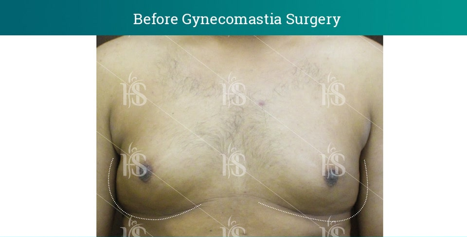 Gynecomastia-Surgery_10653-min 1