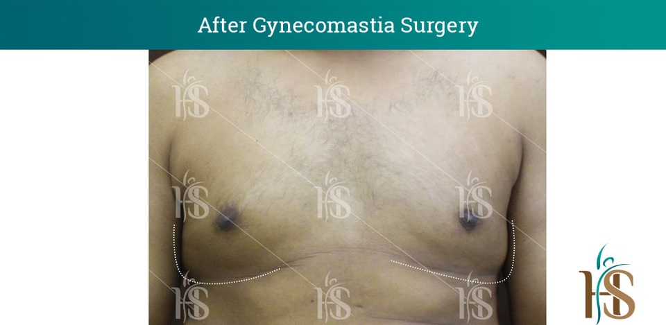 Gynecomastia-Surgery_10653-min 2