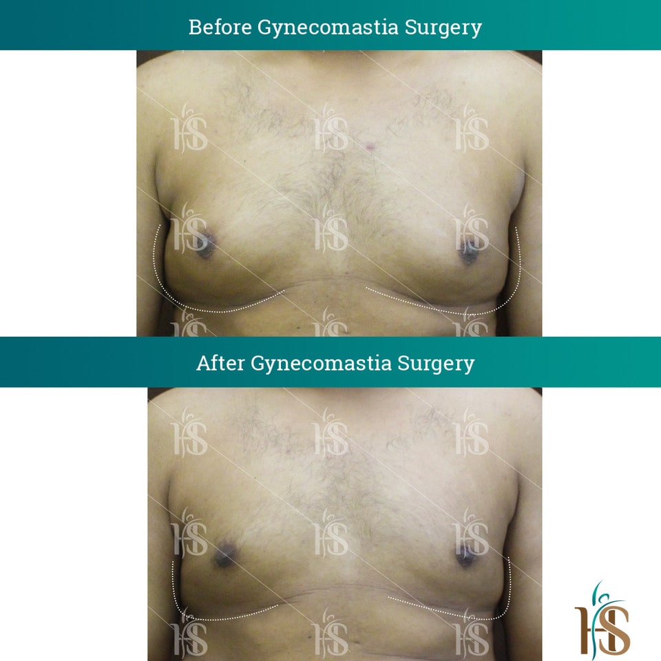 Gynecomastia-Surgery_10653-min