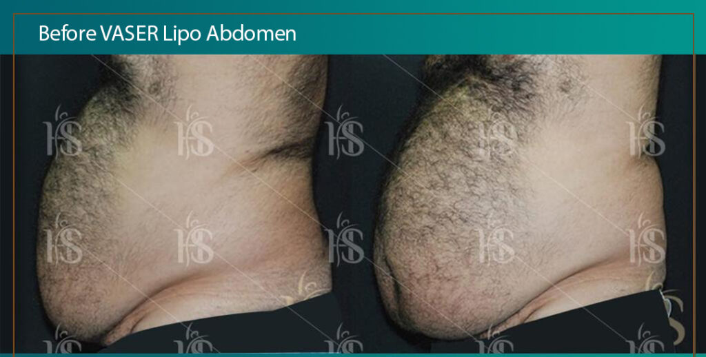 VASER-Lipo-Abdomen-1024x1024-1 1