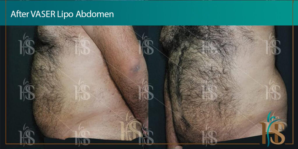VASER-Lipo-Abdomen-1024x1024-1 2
