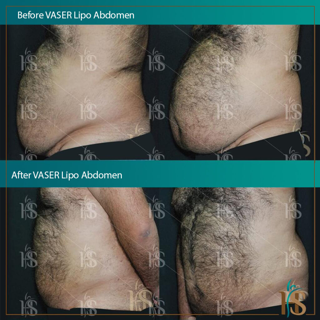 VASER-Lipo-Abdomen-1024x1024
