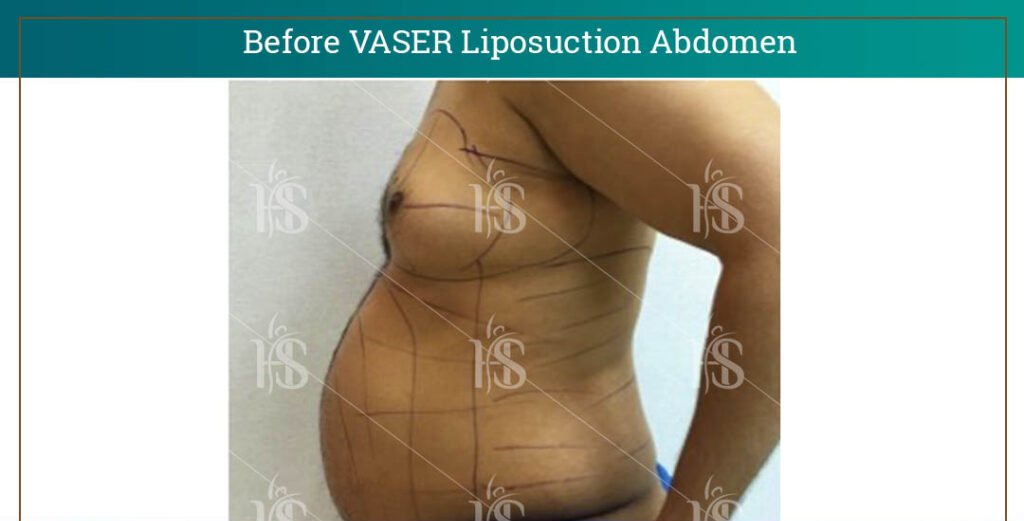 VASER-Liposuction-Abdomen-1-1024x1024-1 1