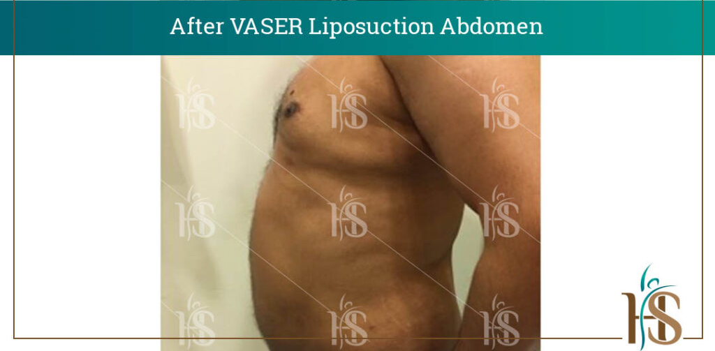 VASER-Liposuction-Abdomen-1-1024x1024-1 2