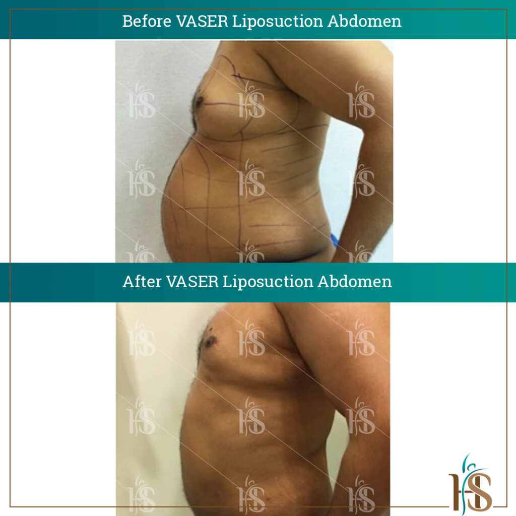 VASER-Liposuction-Abdomen-1-1024x1024