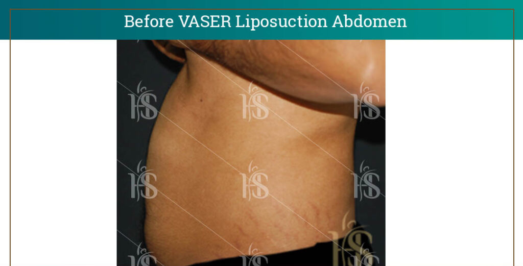 VASER-Liposuction-Abdomen-3-1024x1024-1 1