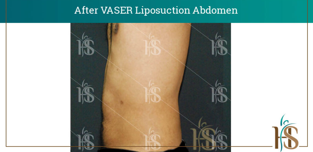 VASER-Liposuction-Abdomen-3-1024x1024-1 2