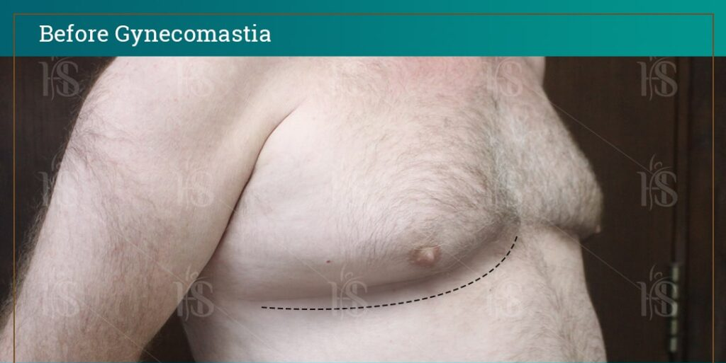 before-and-after-GYNECOMASTIA11268-min-1024x1024-1 1