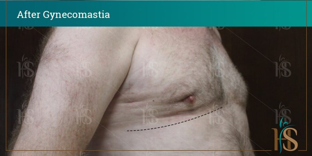 before-and-after-GYNECOMASTIA11268-min-1024x1024-1 2