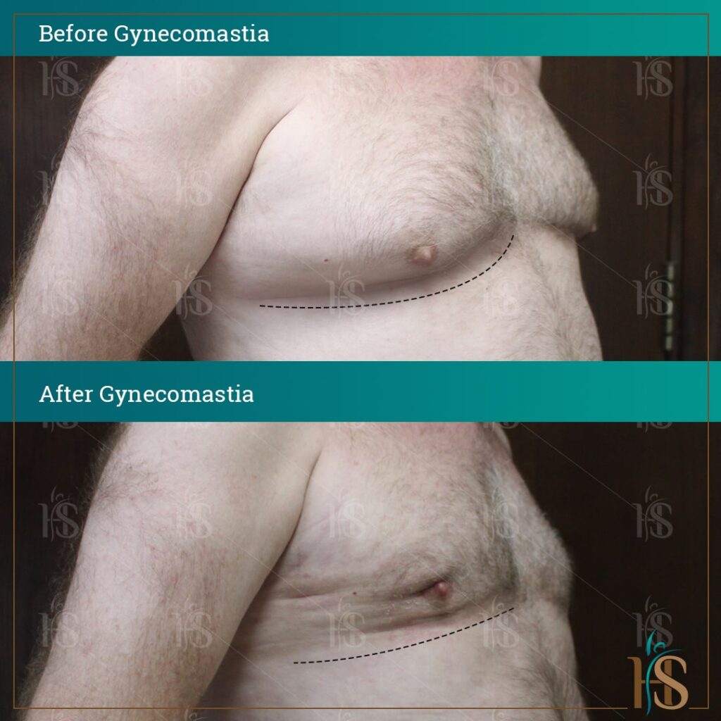 before-and-after-GYNECOMASTIA11268-min-1024x1024