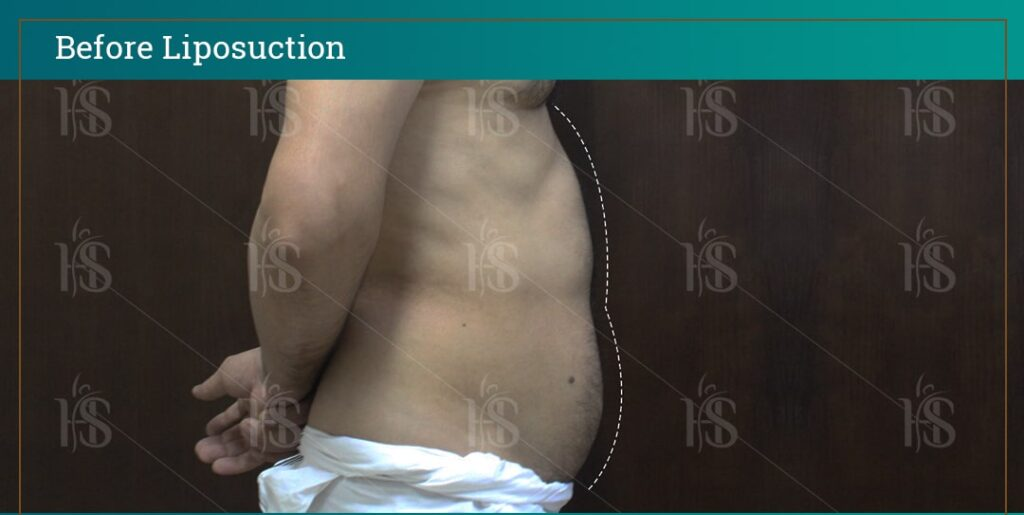 before-and-after-LIPOSUCTION-11269-min-1024x1024-1 1