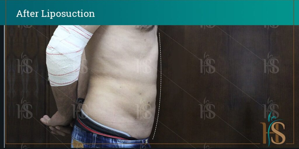 before-and-after-LIPOSUCTION-11269-min-1024x1024-1 2