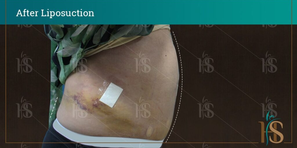 before-and-after-LIPOSUCTION11308-min-1024x1024-1 1