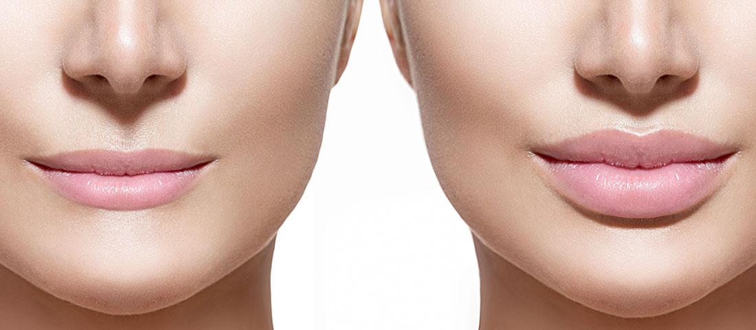 lip fillers with Dr. Hasan Ali - top cosmetic surgeon in UK