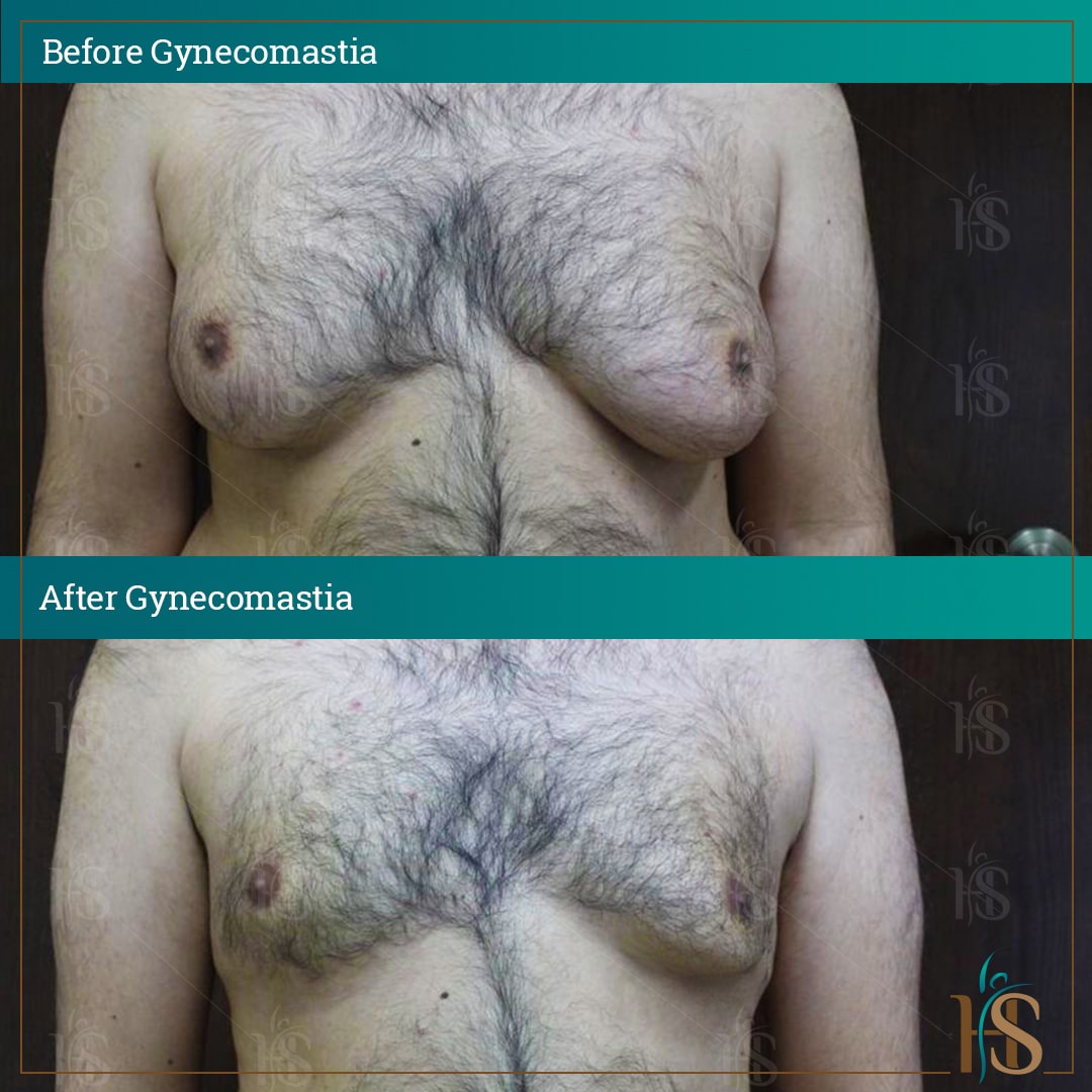 gynecomastia surgery before after results - by Dr. Hasan Ali - best gynecomastia surgeon in London UK