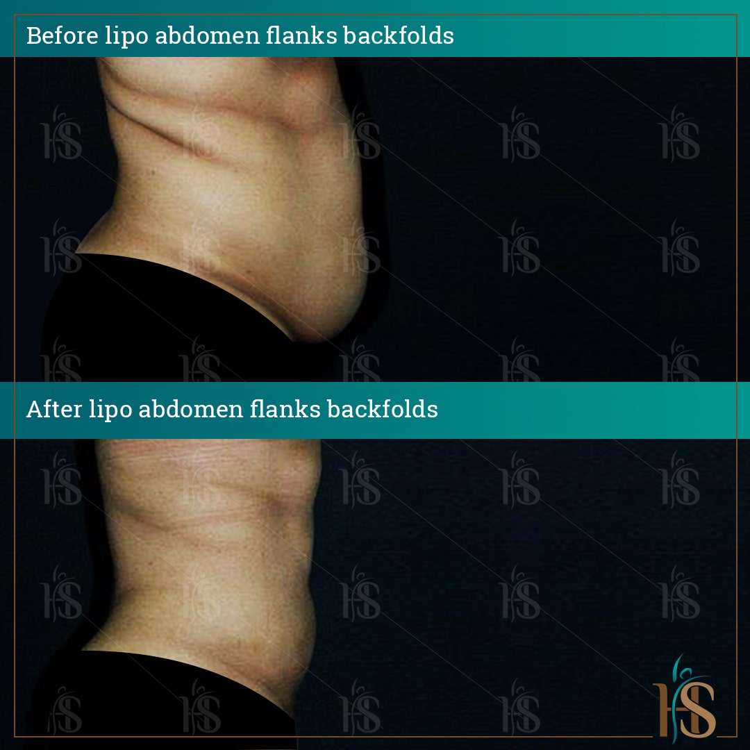 vaser lipo abdomen flanks backfolds