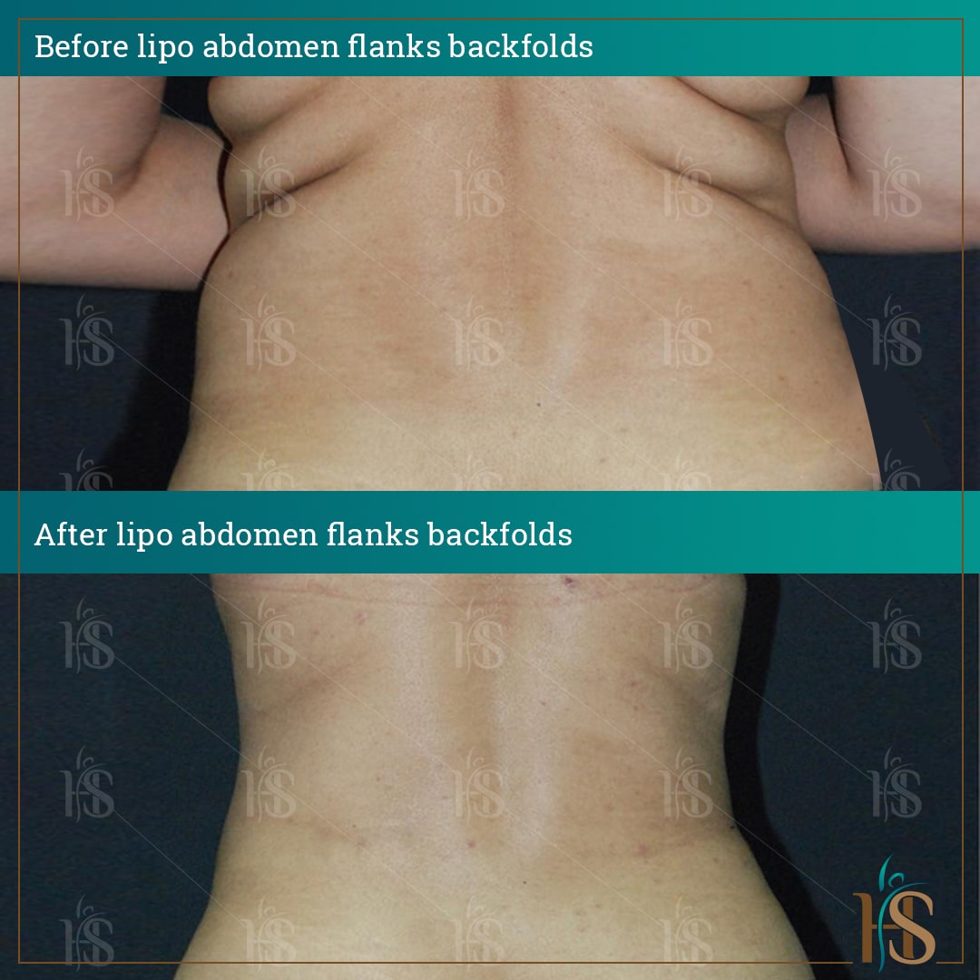 liposuction before after results - by Dr. Hasan Ali - best liposuction surgeon in London