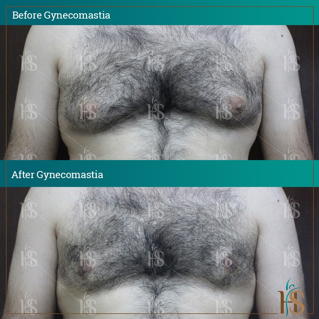 Gynecomastia surgery London - before after results - by Hasan Surgery