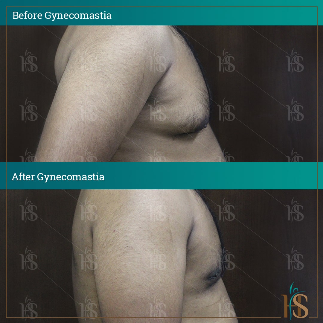 male chest reduction surgery uk - before after results - by Hasan Surgery