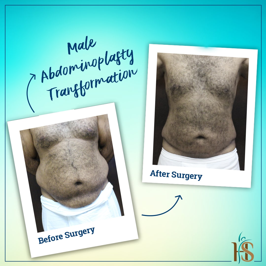 male abdominoplasty in london - before after results - Hasan Surgery