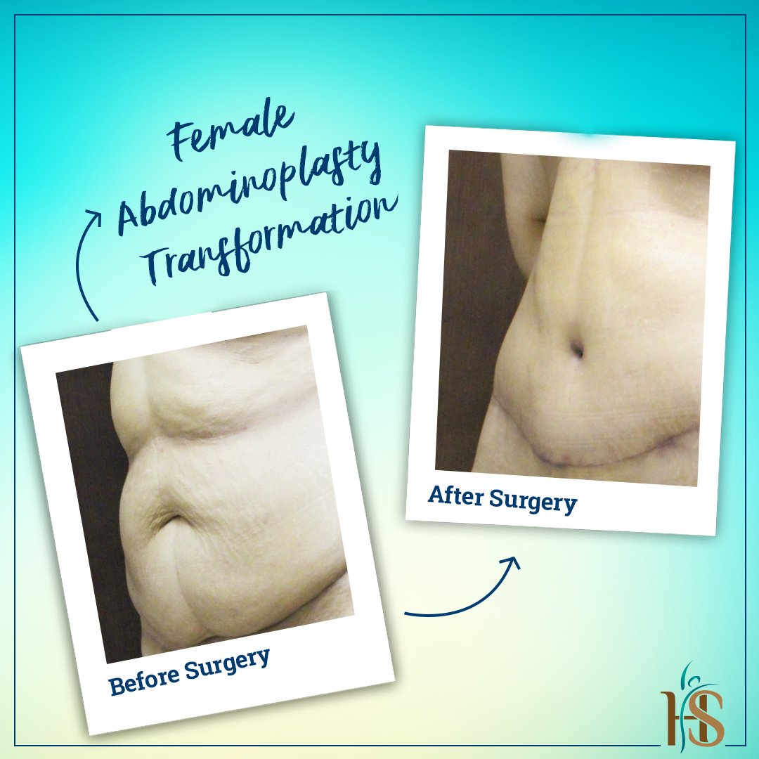 tummy tuck london before after - Hasan Surgery
